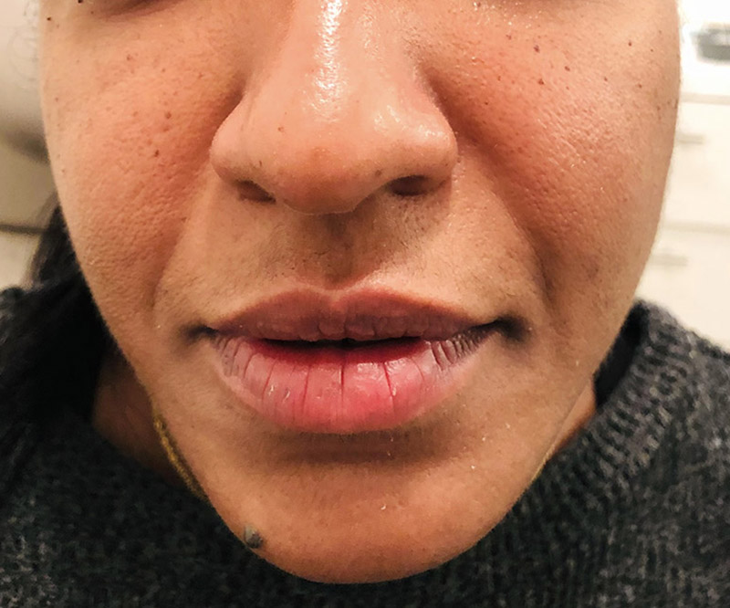 Dermal Fillers Before & After Photo