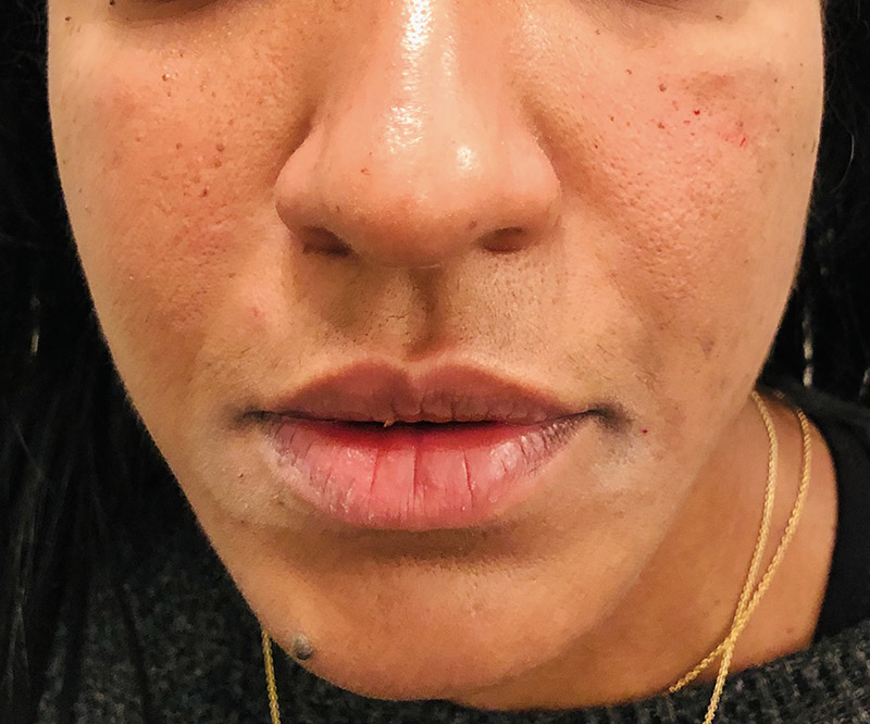 Dermal Fillers Before & After Photo