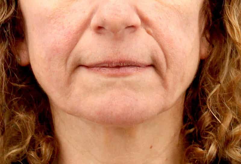 Dermal Fillers Before & After Photo