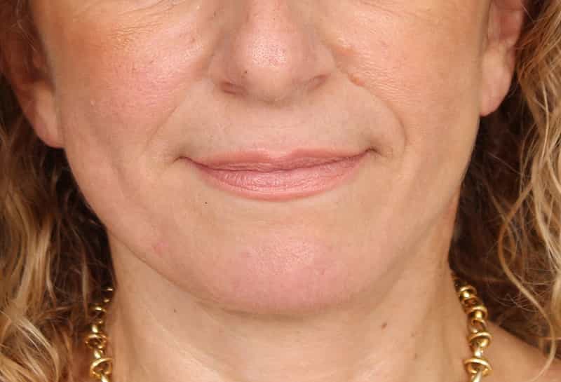 Dermal Fillers Before & After Photo