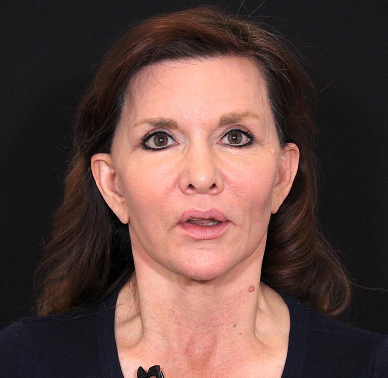Laser Skin Resurfacing Before & After Photo