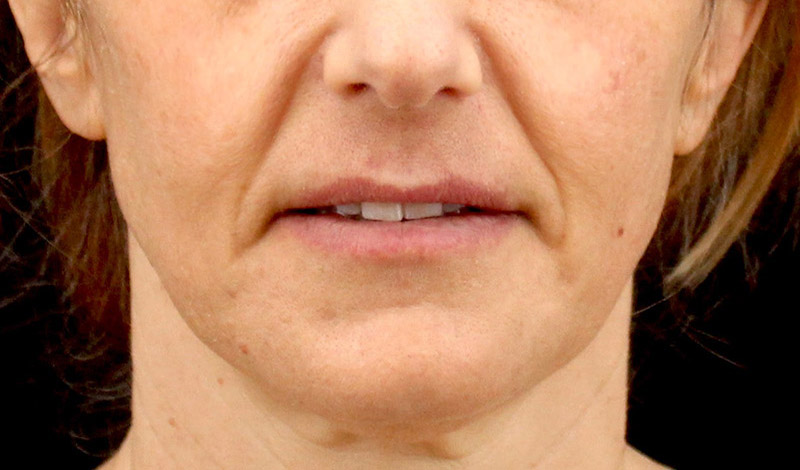 Laser Skin Resurfacing Before & After Photo