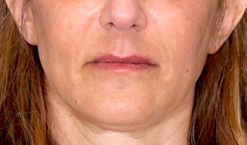 Laser Skin Resurfacing Before & After Photo